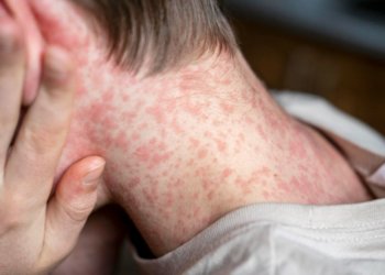 Alerta de sarampo no Brasil acende sinal de atenção com alta de casos em São Paulo