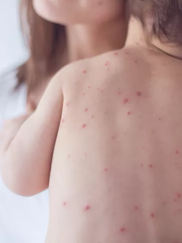 Casos de sarampo em São Paulo põem em risco status de país livre da doença