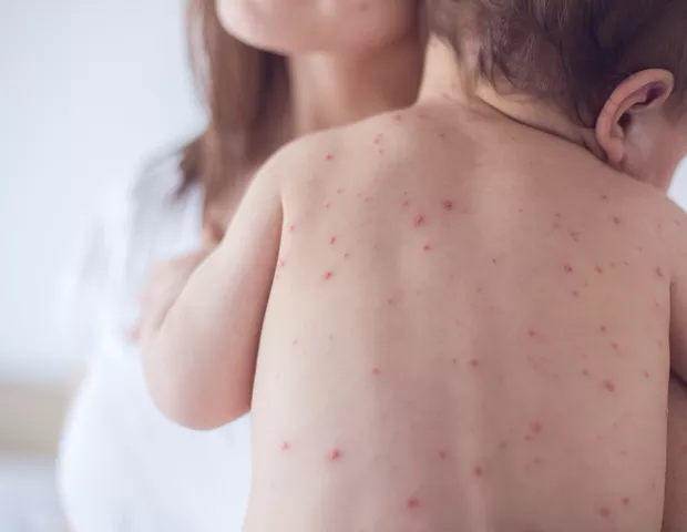 Casos de sarampo em São Paulo põem em risco status de país livre da doença