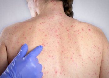 Sarampo avança em São Paulo e infecta maioria de pacientes sem vacina