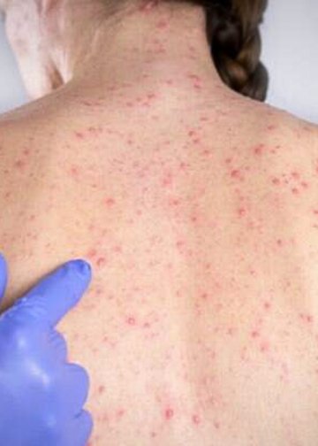 Sarampo avança em São Paulo e infecta maioria de pacientes sem vacina