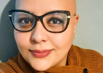 Alopecia areata mobiliza pacientes entre a superação e debates sobre direitos legais