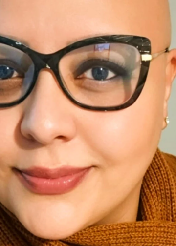 Alopecia areata mobiliza pacientes entre a superação e debates sobre direitos legais